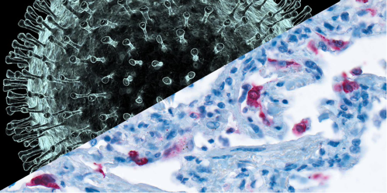 First reported autopsy of patient with MERS coronavirus infection provides critical insights