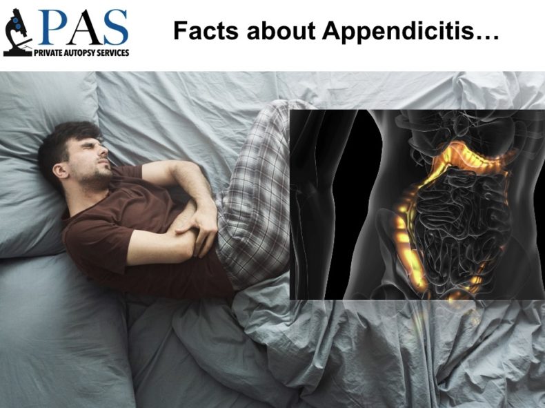 Facts about Appendicitis